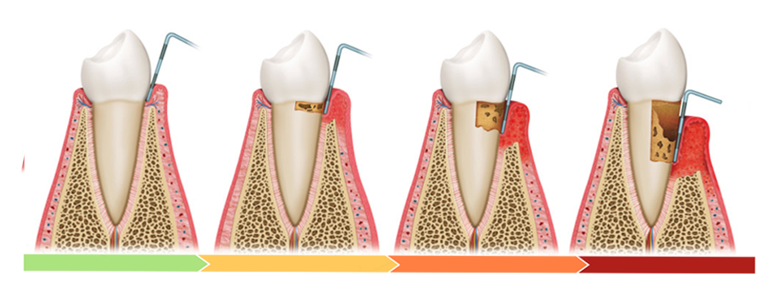 Enfermedades periontales
